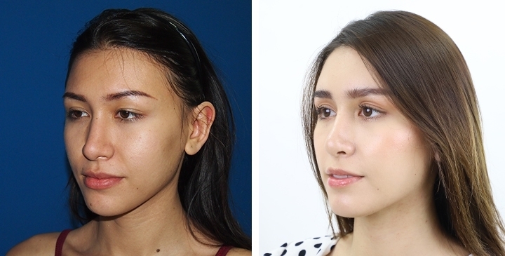 Blepharoplasty / Eyelid Surgery 77 lg 6516cdb99e453 image