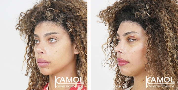 Blepharoplasty / Eyelid Surgery 17 lg 6531ec81e6642 image