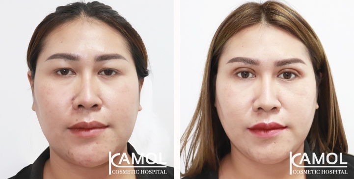 Blepharoplasty / Eyelid Surgery 22 lg 6538846de3ea4 image