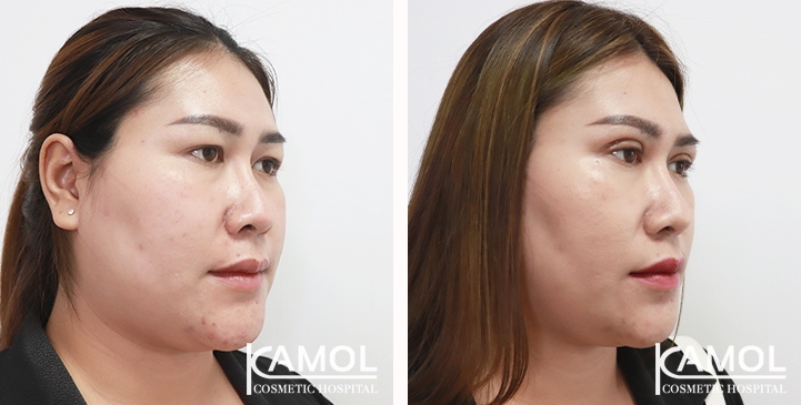 Blepharoplasty / Eyelid Surgery 23 lg 65388474886e5 image