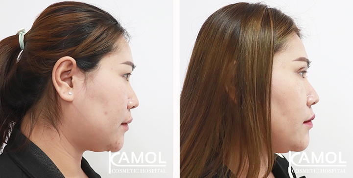 Blepharoplasty / Eyelid Surgery 24 lg 653884778c9f1 image