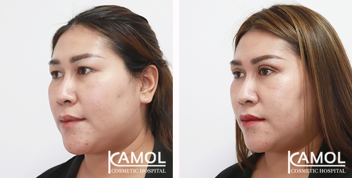 Blepharoplasty / Eyelid Surgery 26 lg 6538847abe236 image