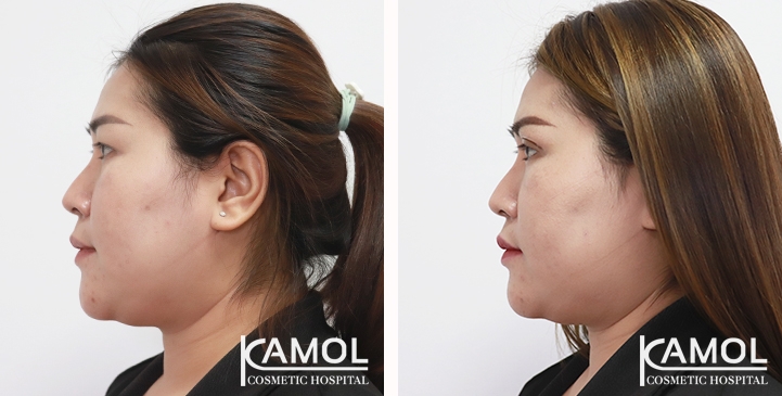 Blepharoplasty / Eyelid Surgery 25 lg 6538847dd8445 image