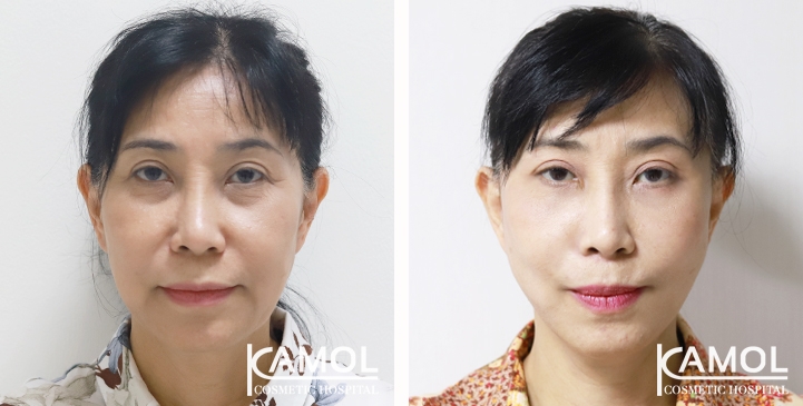 Face Lift 8 lg 65b87f2057be2 image