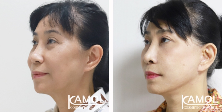 Face Lift 10 lg 65b87f2090437 image