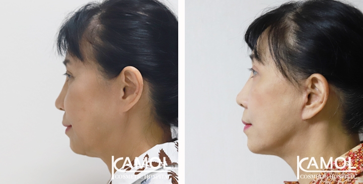 Face Lift 12 lg 65b87f20c5345 image