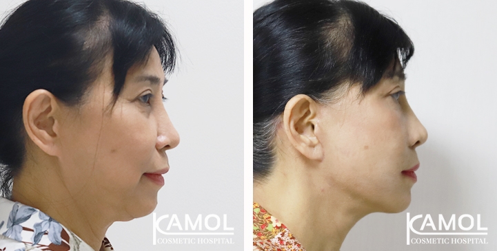 Face Lift 11 lg 65b87f21009df image