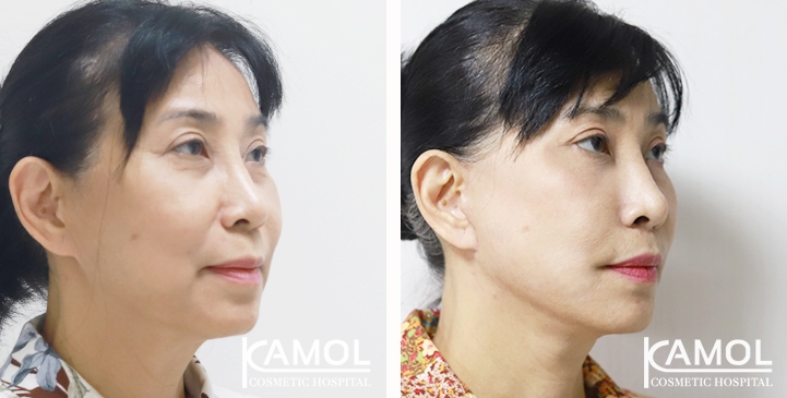 Face Lift 9 lg 65b87f2132029 image