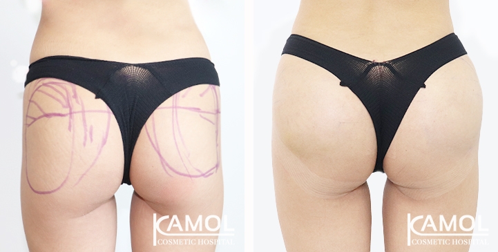 Aumento dei Glutei 57 lg 65eec897ad523 image