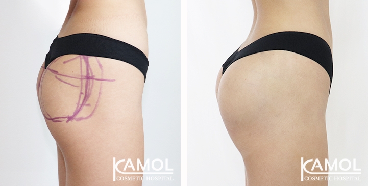 Aumento dei Glutei 59 lg 65eec89a53a23 image