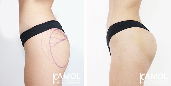 Aumento dei Glutei 58 lg 65eec89f203a6 image