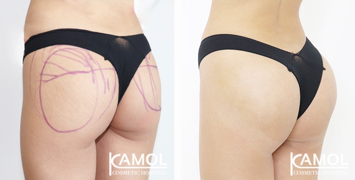 Aumento dei Glutei 61 lg 65eec8a0ef443 image