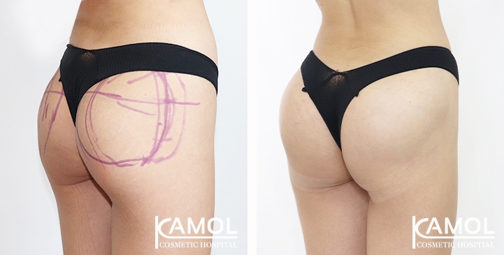 Aumento dei Glutei 60 lg 65eec8a966a61 image