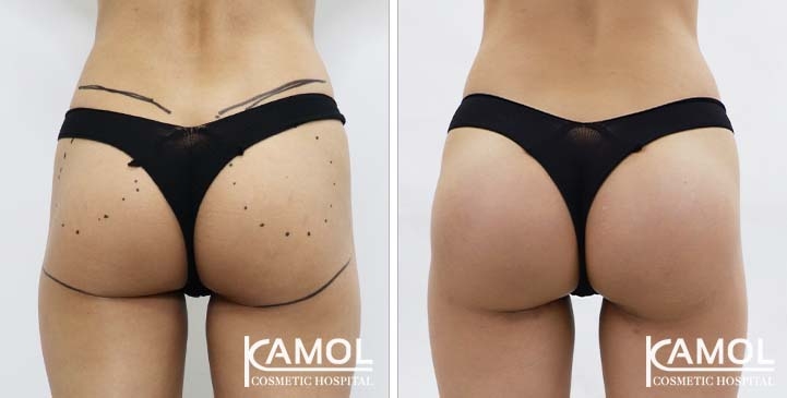 Aumento dei Glutei 63 lg 65eec96616f14 image