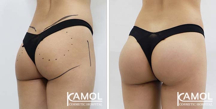 Aumento dei Glutei 65 lg 65eec9663428e image