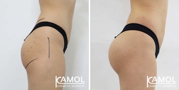 Aumento dei Glutei 64 lg 65eec9665554c image