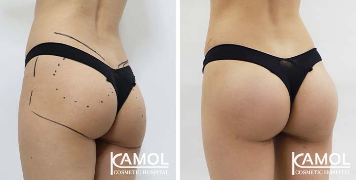 Aumento dei Glutei 66 lg 65eec96672a1e image