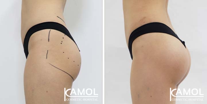Aumento dei Glutei 67 lg 65eec9668d5b6 image