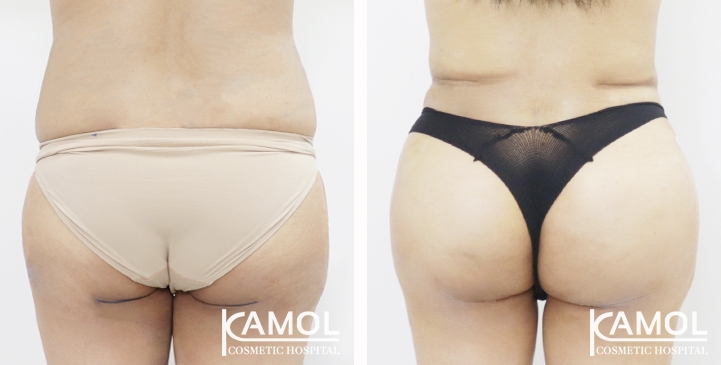 Aumento dei Glutei 69 lg 65eec9c145096 image