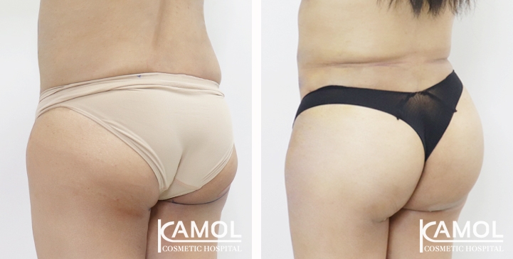 Aumento dei Glutei 71 lg 65eec9c166f07 image