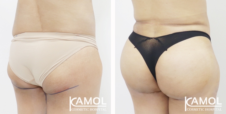 Aumento dei Glutei 70 lg 65eec9c1876d2 image