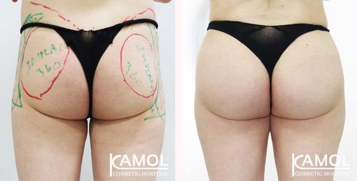 Aumento dei Glutei 73 lg 65eeca4dd5438 image
