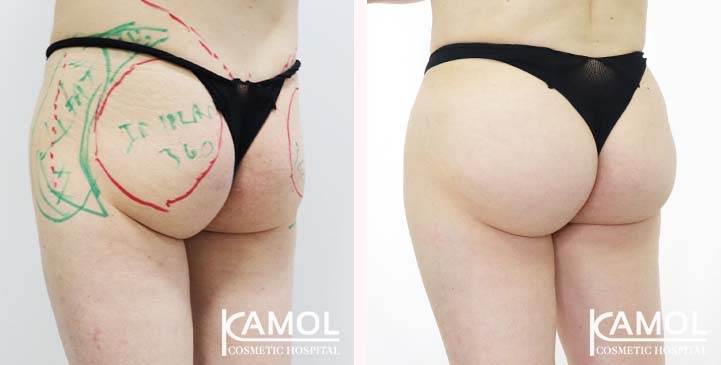 Aumento dei Glutei 77 lg 65eeca4df2d69 image
