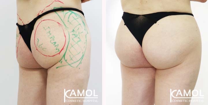 Aumento dei Glutei 76 lg 65eeca4e1bca1 image