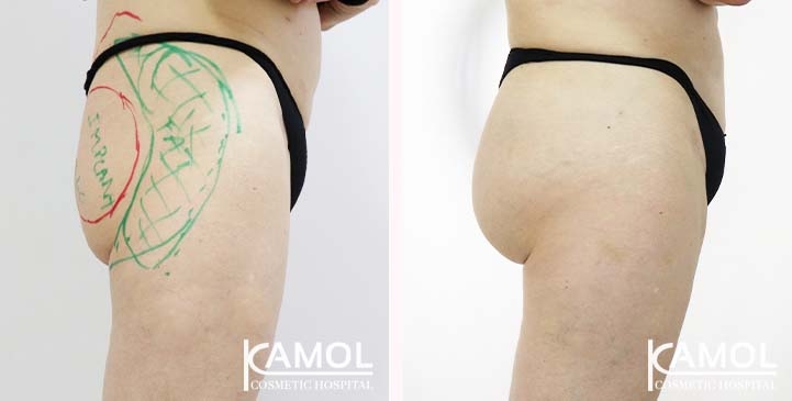 Aumento dei Glutei 75 lg 65eeca4e393ab image