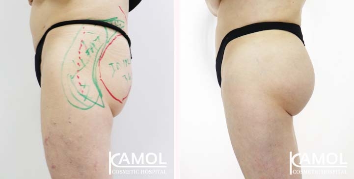 Aumento dei Glutei 74 lg 65eeca4e57438 image