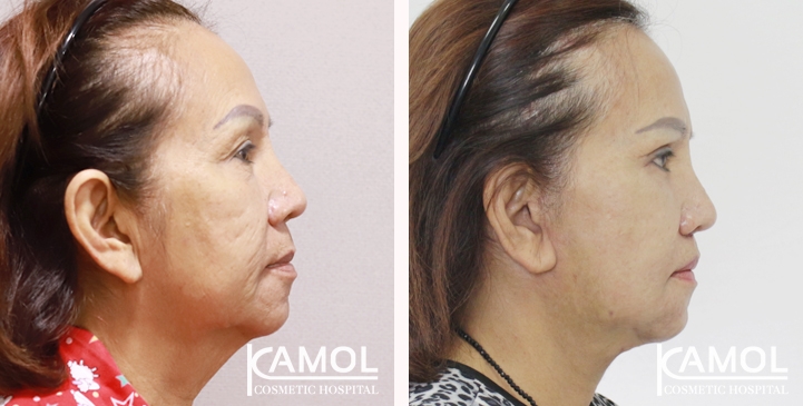 Face Lift 6 lg 6605274fa0d93 image