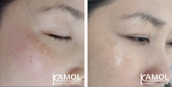 Melasma 6 lg 6610c41bda2b9 image