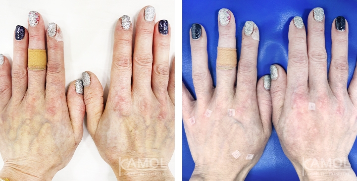 Hand Rejuvenation Treatment 8 lg 661659c39ba26 image