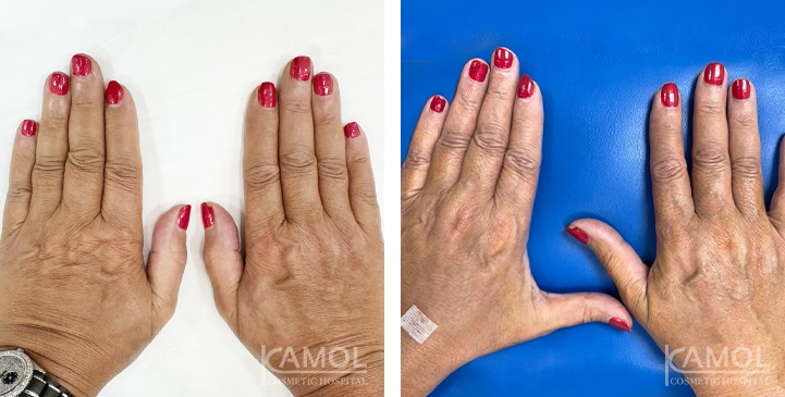 Hand Rejuvenation Treatment 10 lg 66165b37227bf image