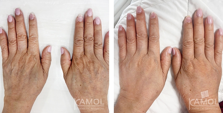 Hand Rejuvenation Treatment 12 lg 66165b5a7ec0b image