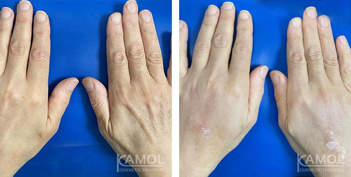 Hand Rejuvenation Treatment 14 lg 66165b7911151 image