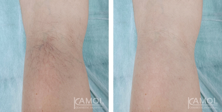 Varices 5 lg 6617bb75e6b3a image