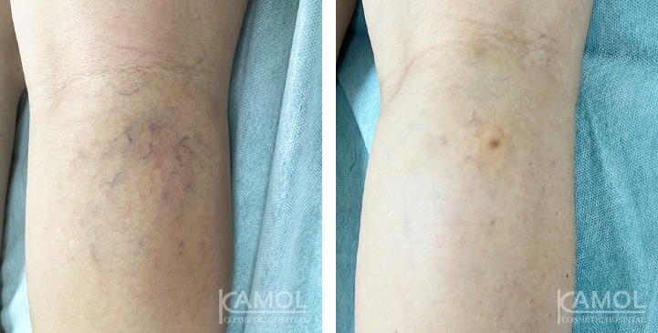 Varices 7 lg 6617bc0861e00 image