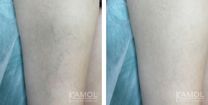 Varices 9 lg 6617bc4f347ba image