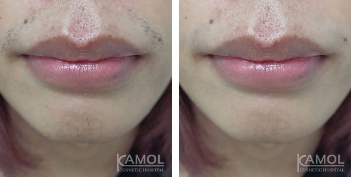 Remoção de Pelos 8 lg 6617bd1c93501 image
