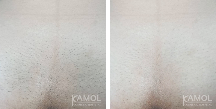 Remoção de Pelos 10 lg 6617bd63d238f image