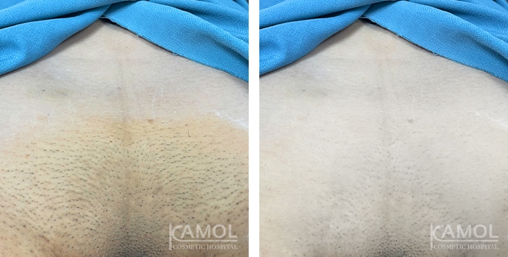 Remoção de Pelos 12 lg 6617bd8f3b629 image