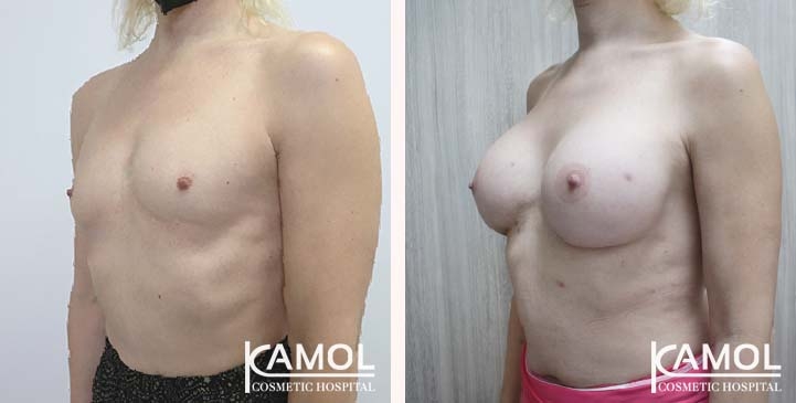 Cirurgia de Mama para Mulheres Trans 39 lg 66387d4638320 image