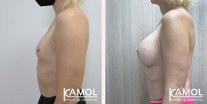 Cirurgia de Mama para Mulheres Trans 40 lg 66387d46544c9 image