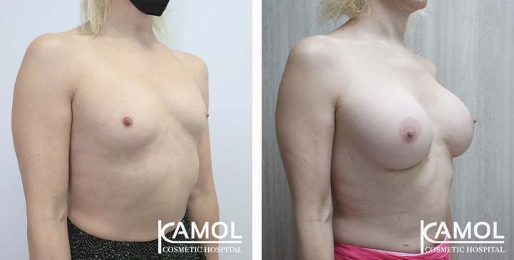 Cirurgia de Mama para Mulheres Trans 38 lg 66387d4671034 image