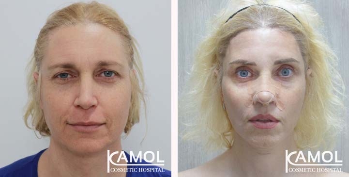 Cirurgia de Feminização Facial / FFS 78 lg 663c574c20cc3 image