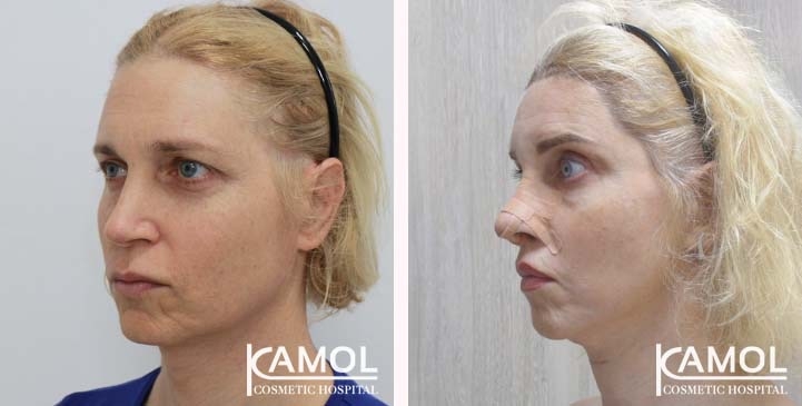 Cirurgia de Feminização Facial / FFS 81 lg 663c575247749 image
