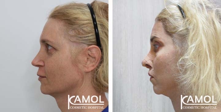 Cirurgia de Feminização Facial / FFS 80 lg 663c57526ad9a image