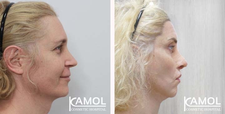 Cirurgia de Feminização Facial / FFS 79 lg 663c5757b5507 image