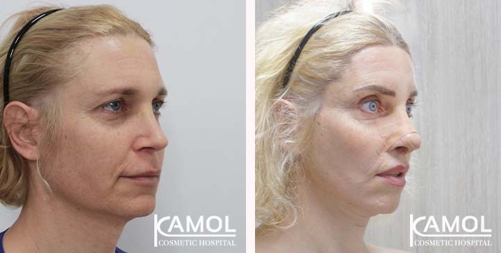 Face Lift 60 lg 663c5810d2a50 image
